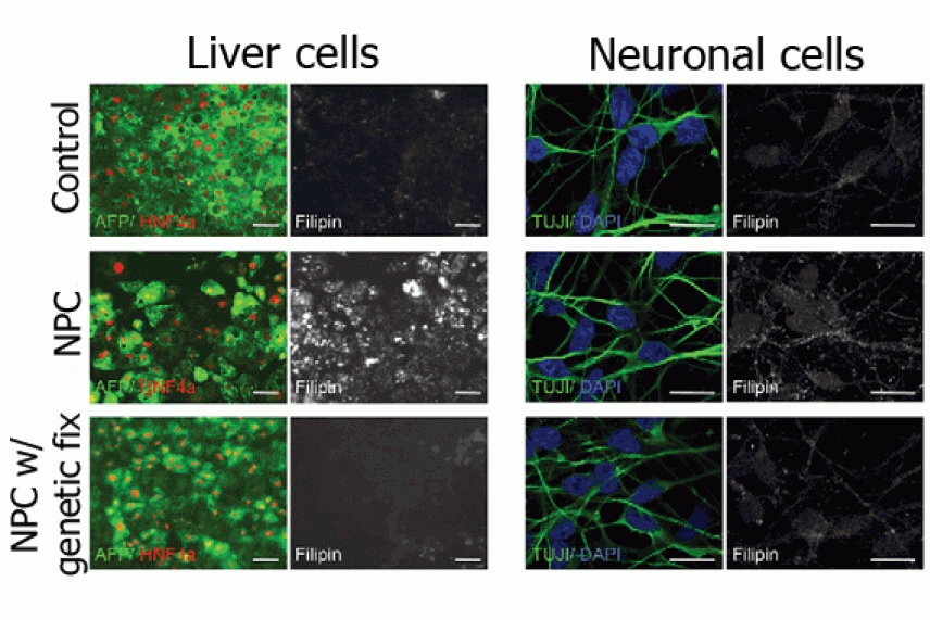 Niemann-Pick Type C Disease - NP-C Genetic Disease - Lysosomal Disease 